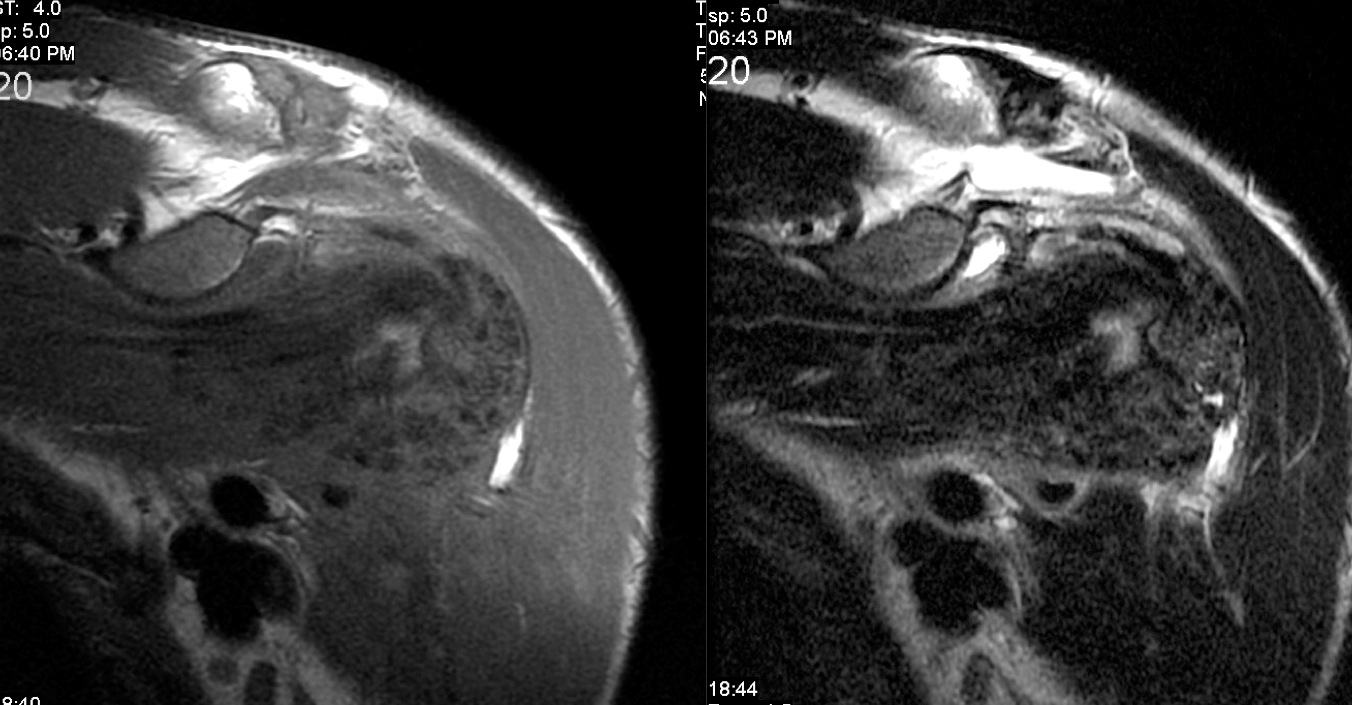 Figure 3 for case tumoral calcinosis ( RID5202 )